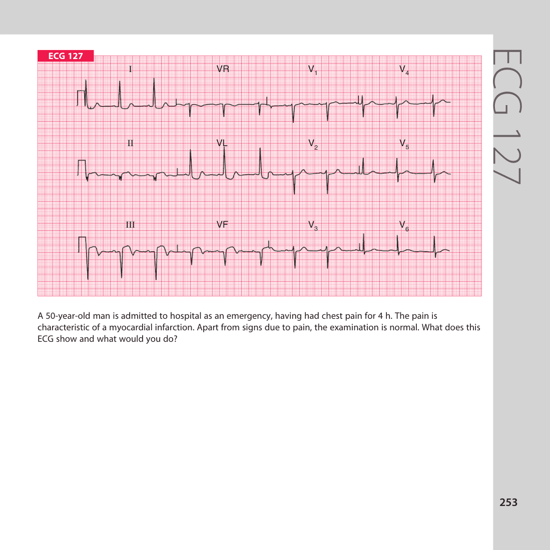 ECG 127