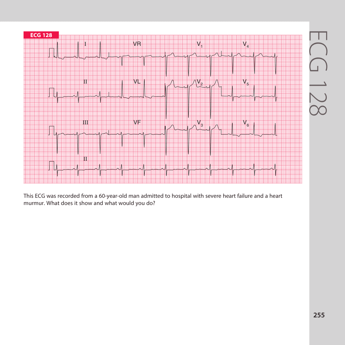 ECG 128