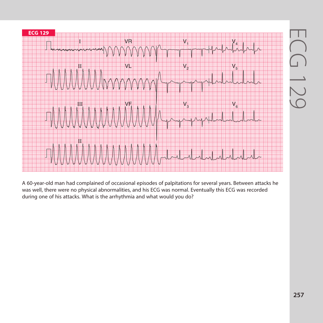 ECG 129