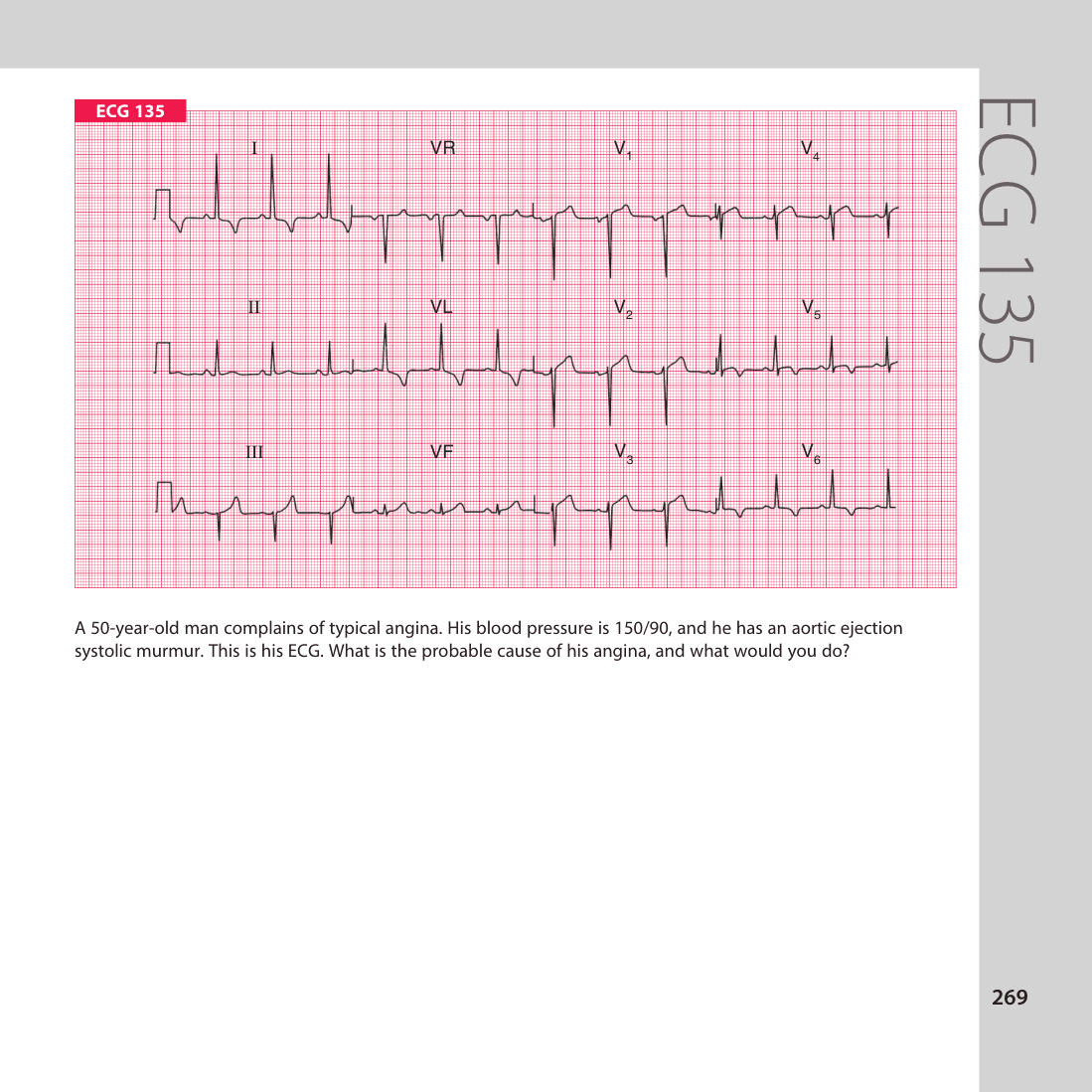 ECG 135