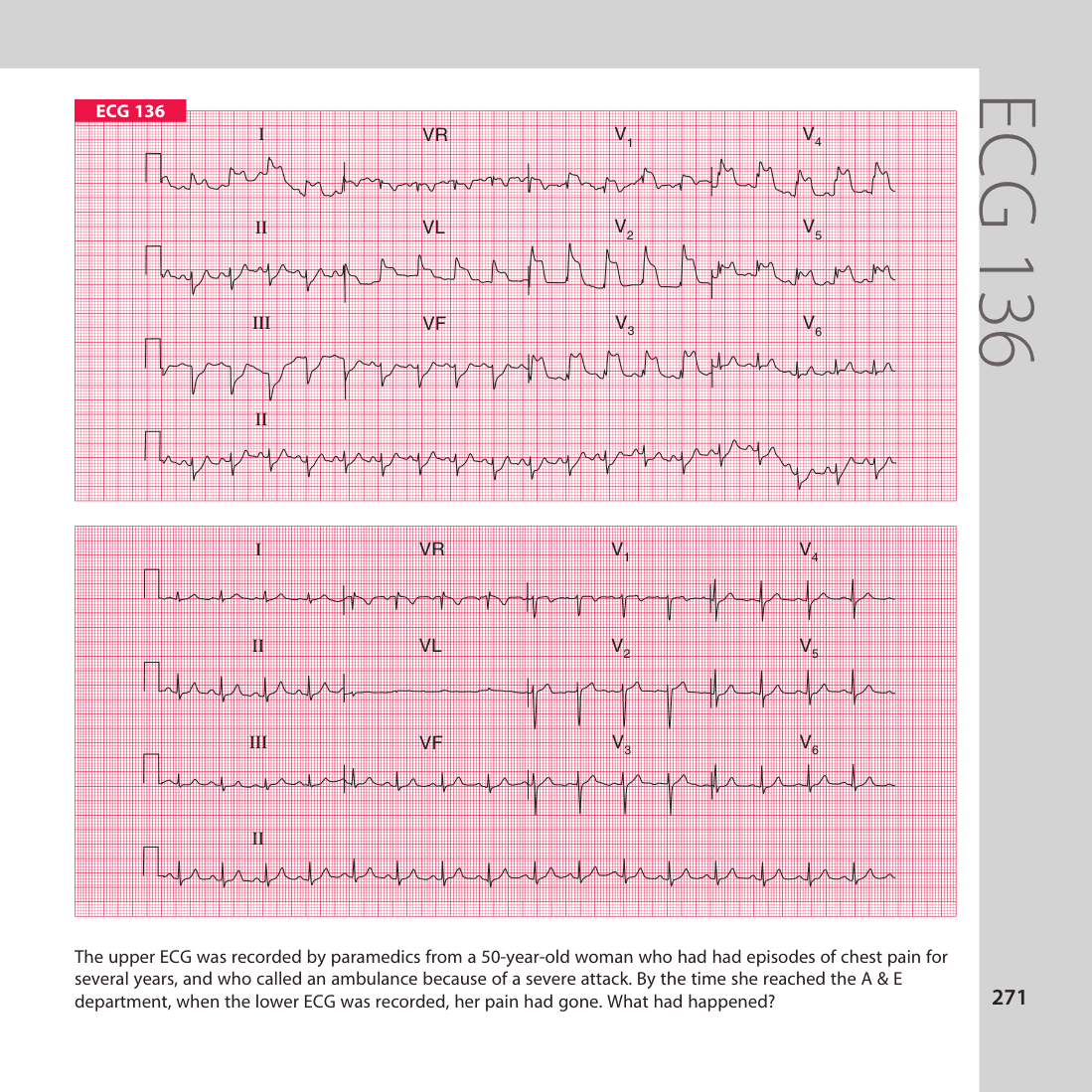 ECG 136