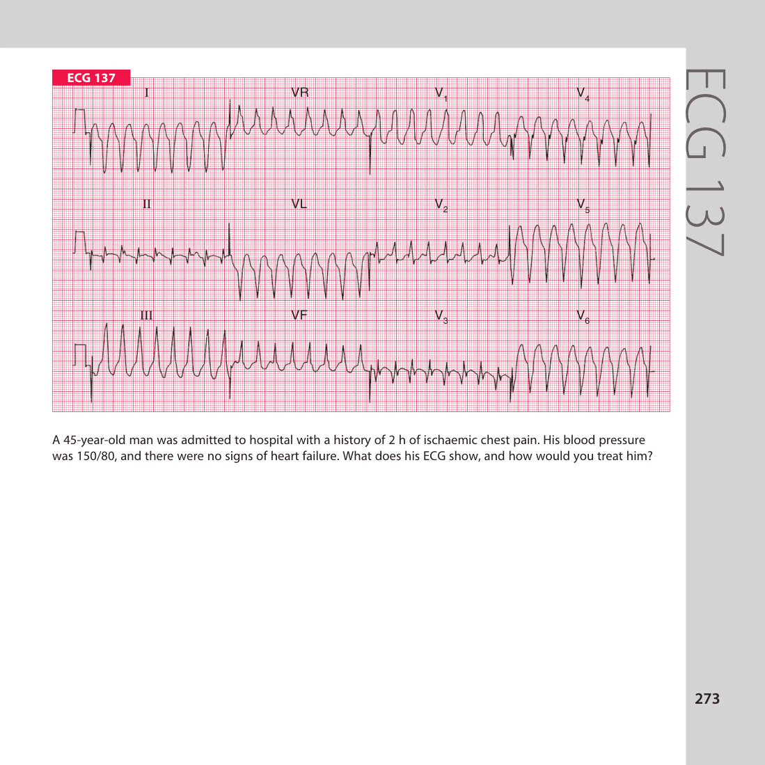 ECG 137