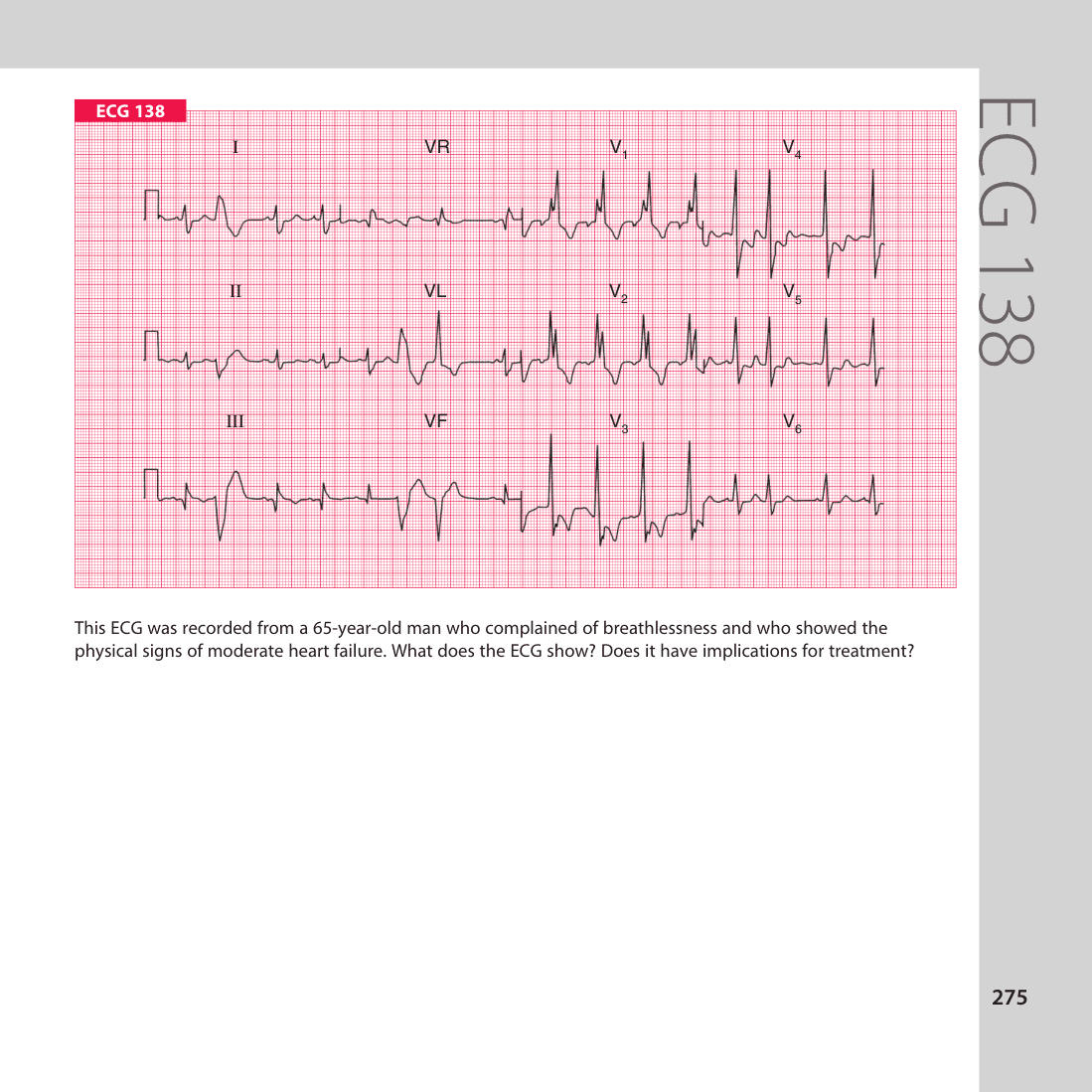ECG 138