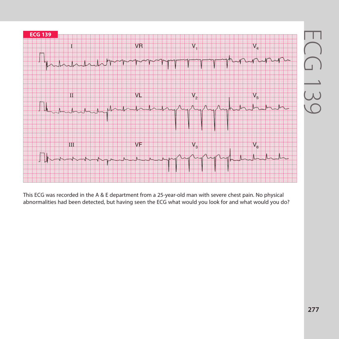 ECG 139