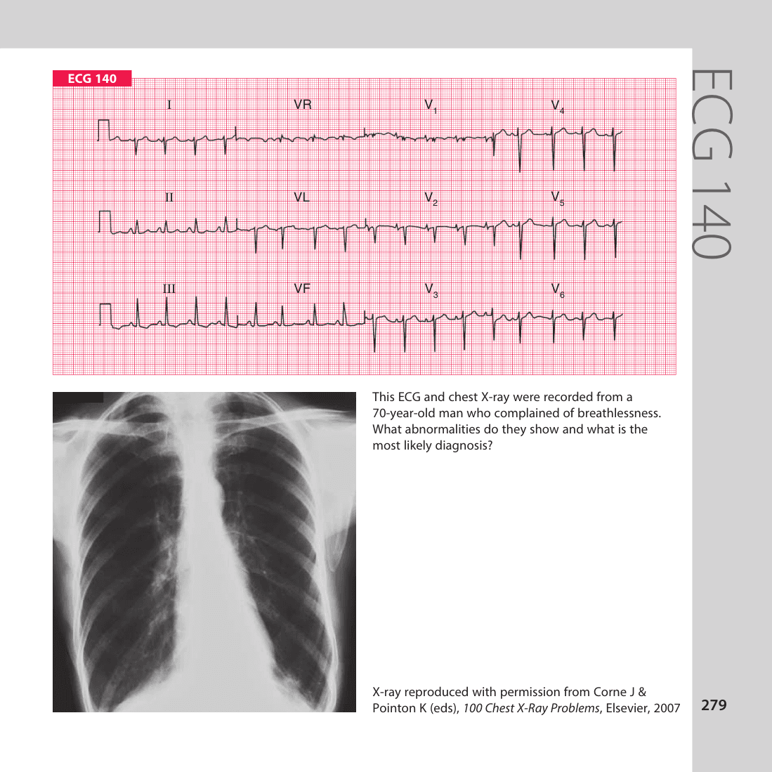 ECG 140