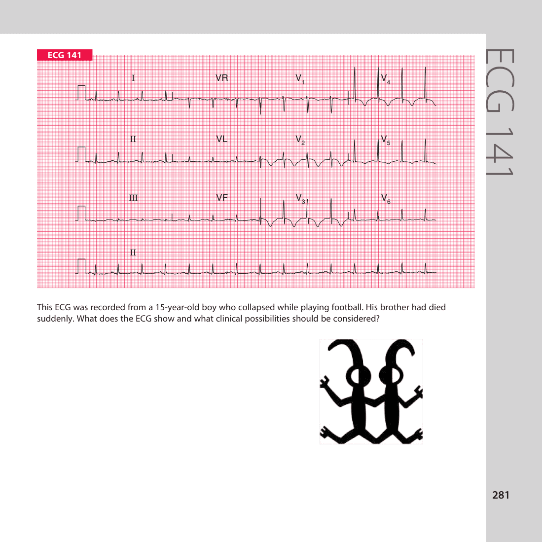 ECG 141