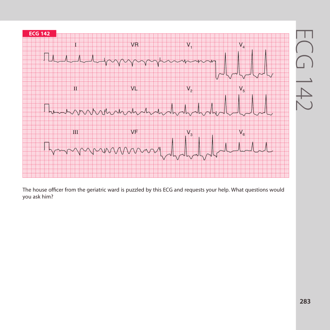 ECG 142