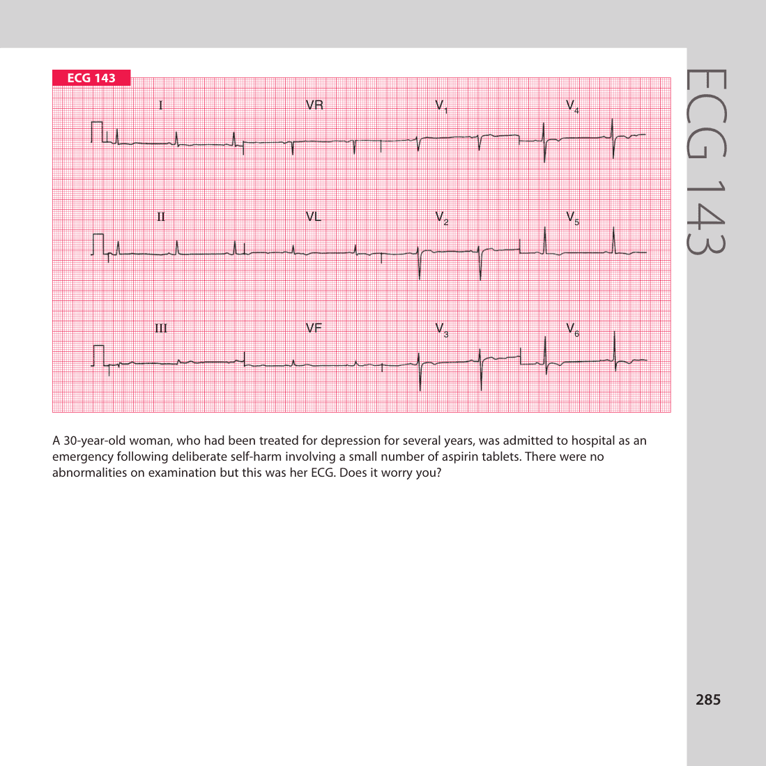 ECG 143