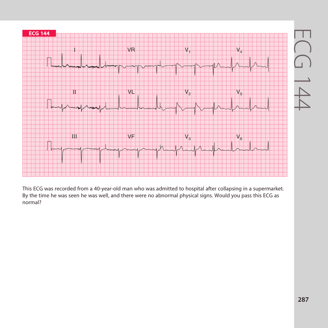 ECG 144