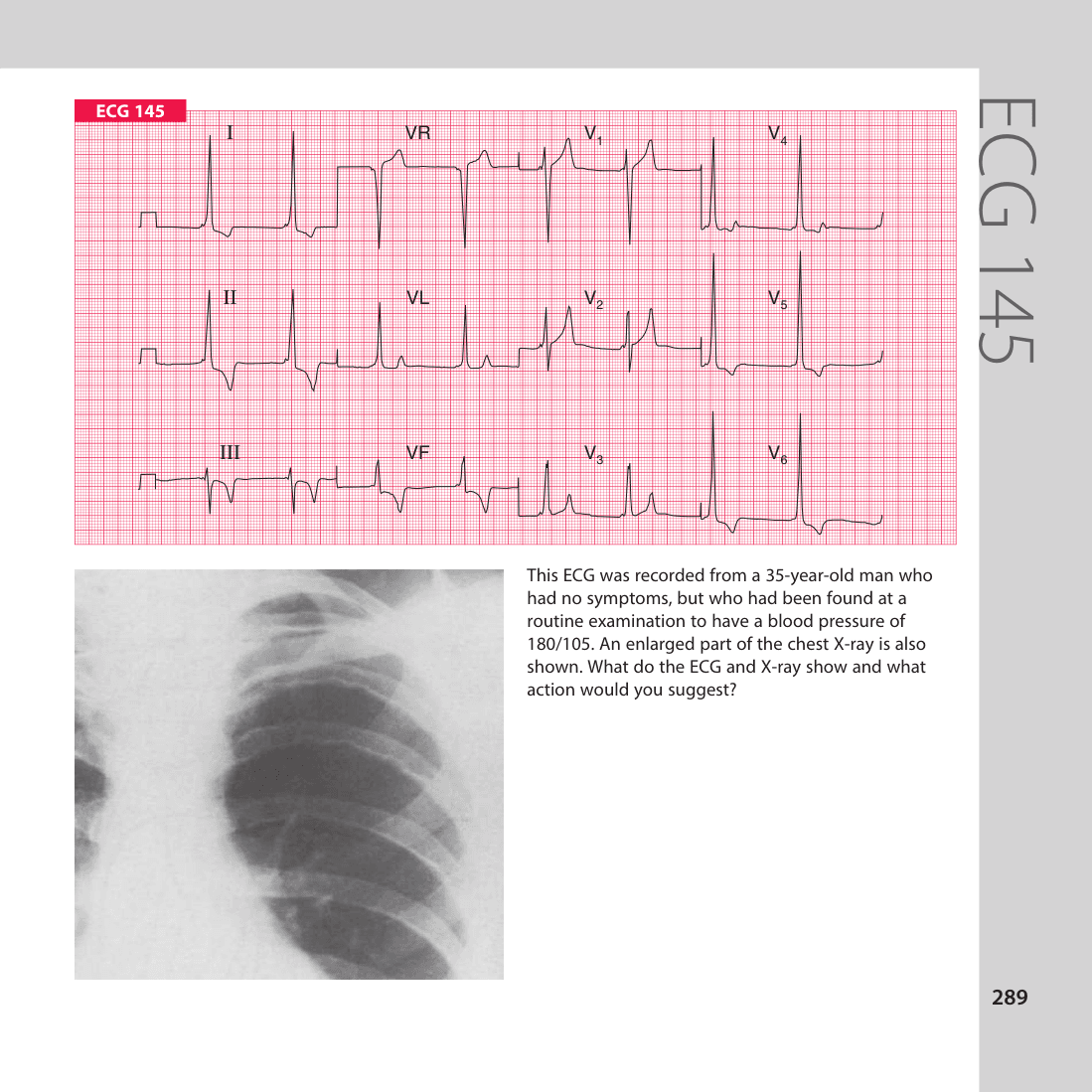 ECG 145