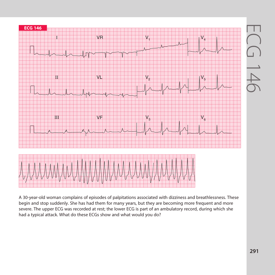 ECG 146