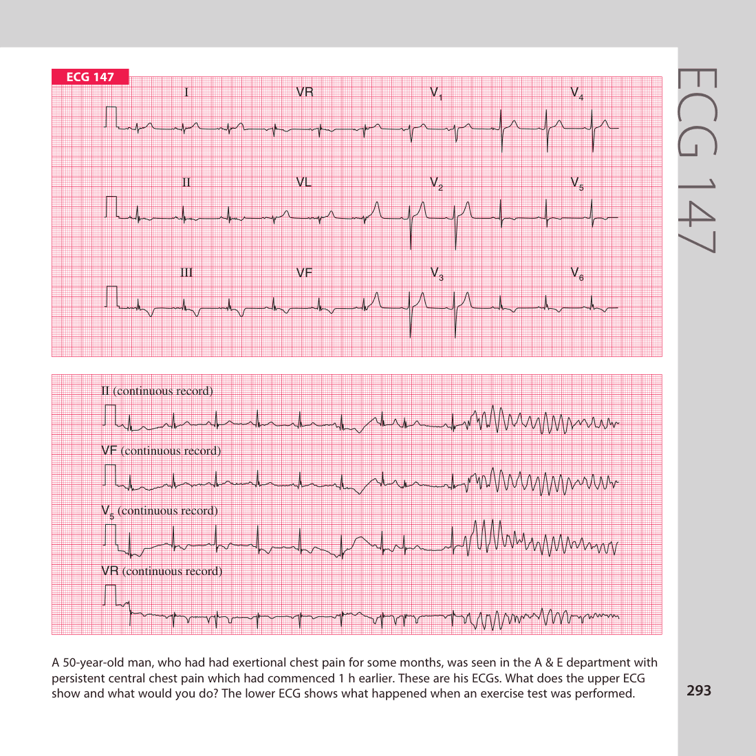 ECG 147