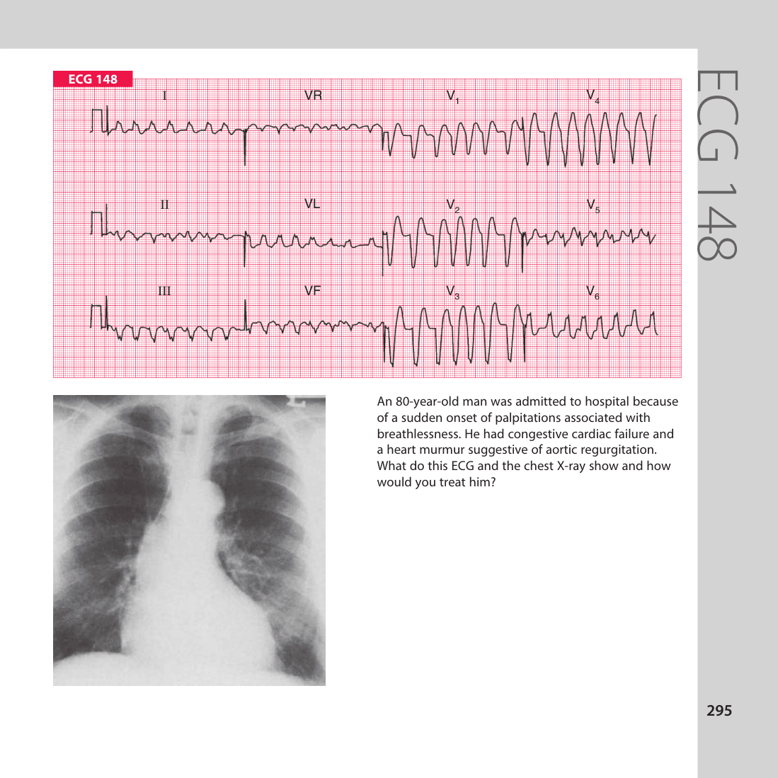 ECG 148