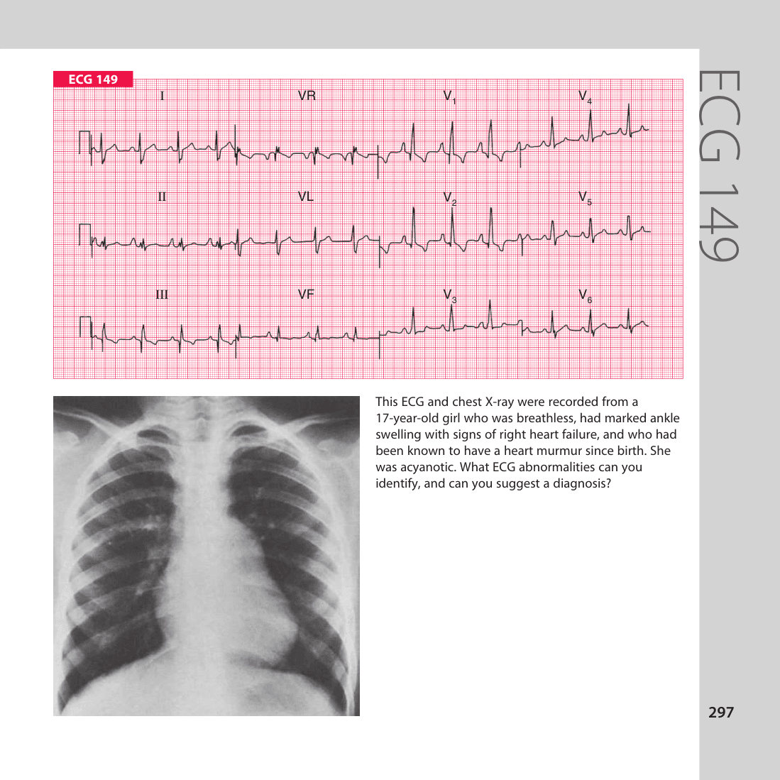 ECG 149