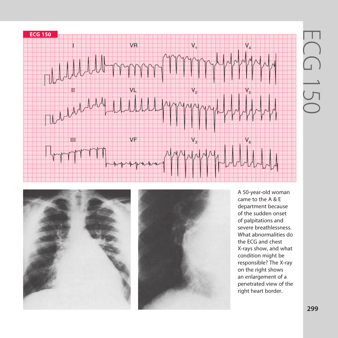 ECG 150